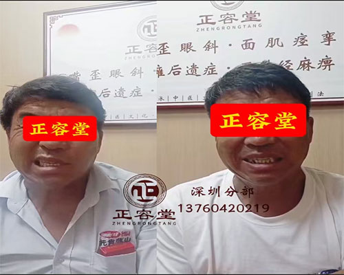 深圳面瘫患者治疗前后对比图