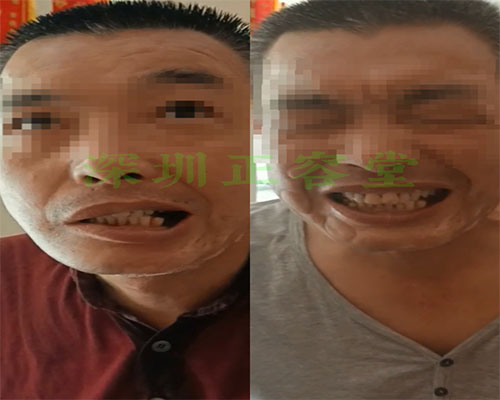 深圳面瘫患者唐先生治疗前后对比图