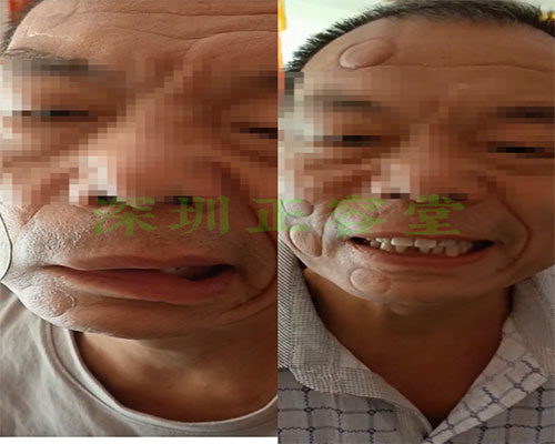 深圳面瘫患者王先生治疗前后呲牙对比图